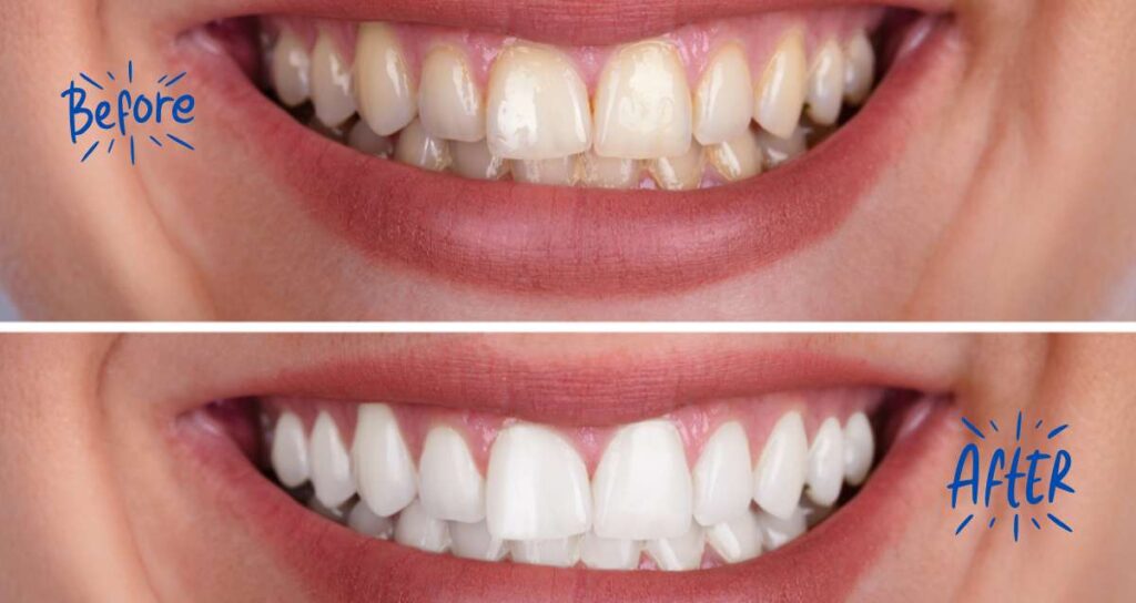 Teeth Whitening